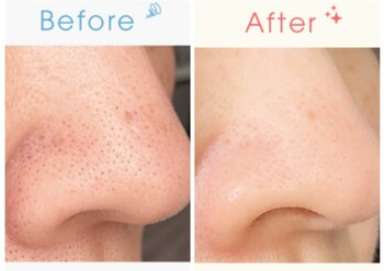 ☆大幅値下げ☆　bijou　毛穴洗浄 毛穴洗浄の頻度は？ - JESSICA